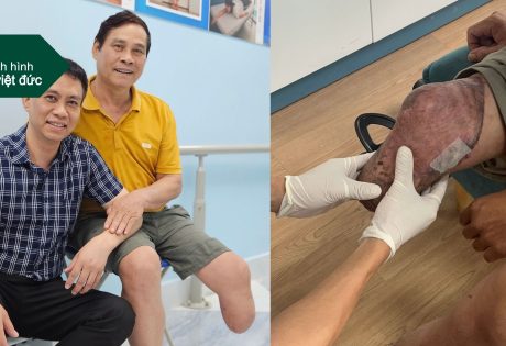 Chân giả dưới gối và kỹ thuật treo bám