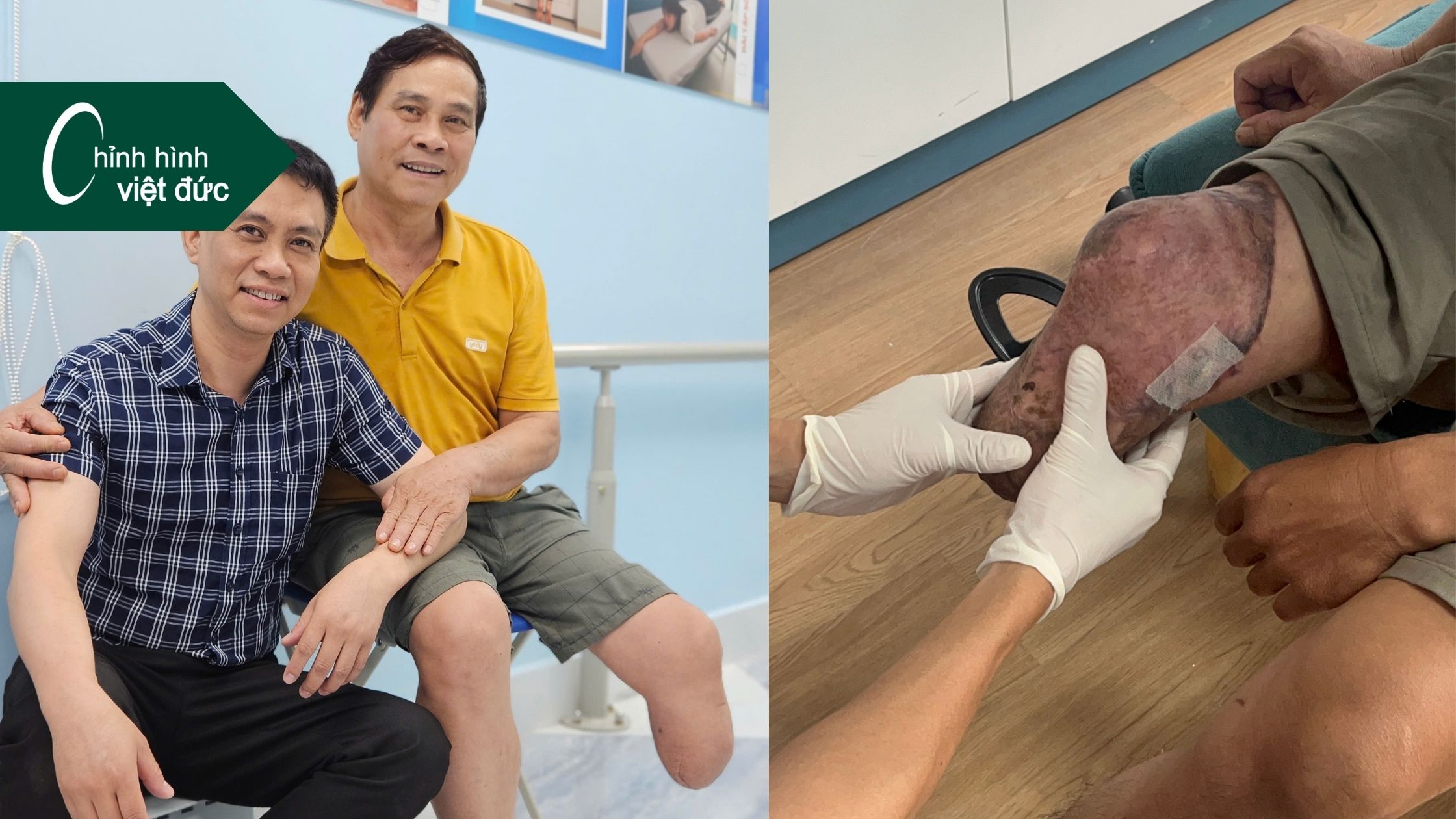 Chân giả dưới gối và kỹ thuật treo bám