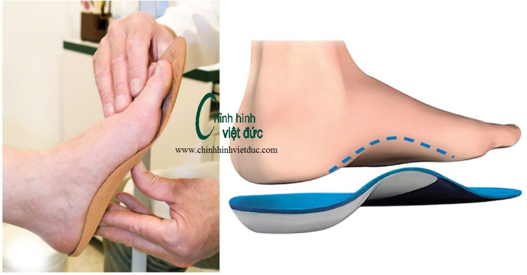 nẹp bàn hiệu quả