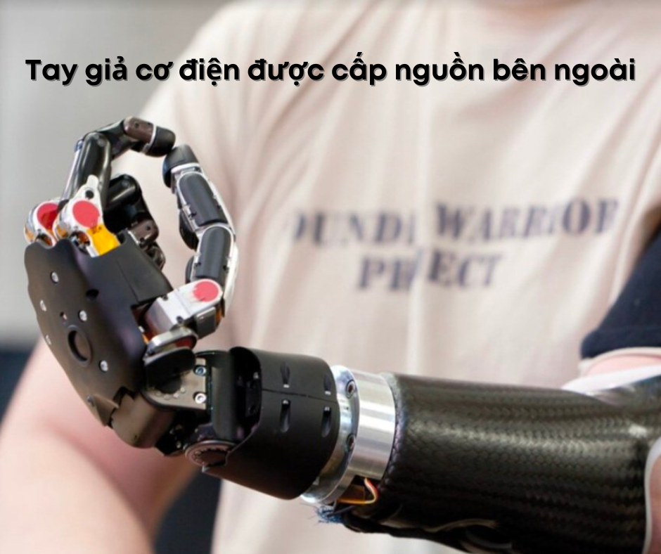 tay giả cơ điện được cấp nguồn bên ngoài
