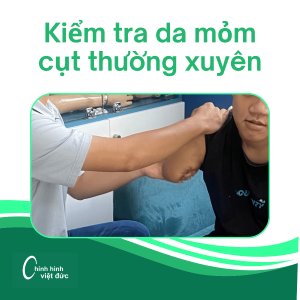 Kiểm tra da mỏm cụt thường xuyên