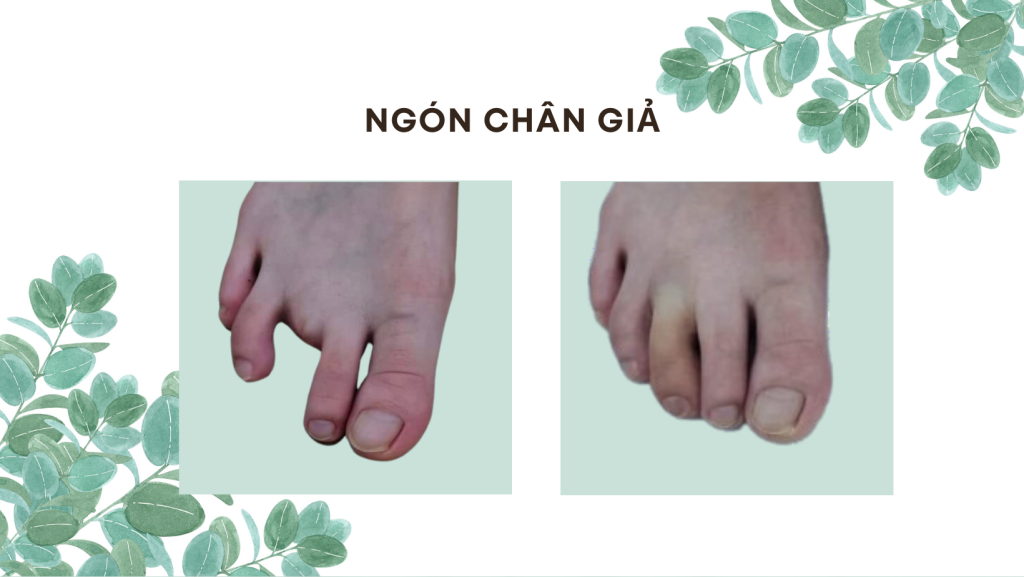 làm ngón chân giả