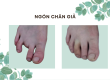 làm ngón chân giả