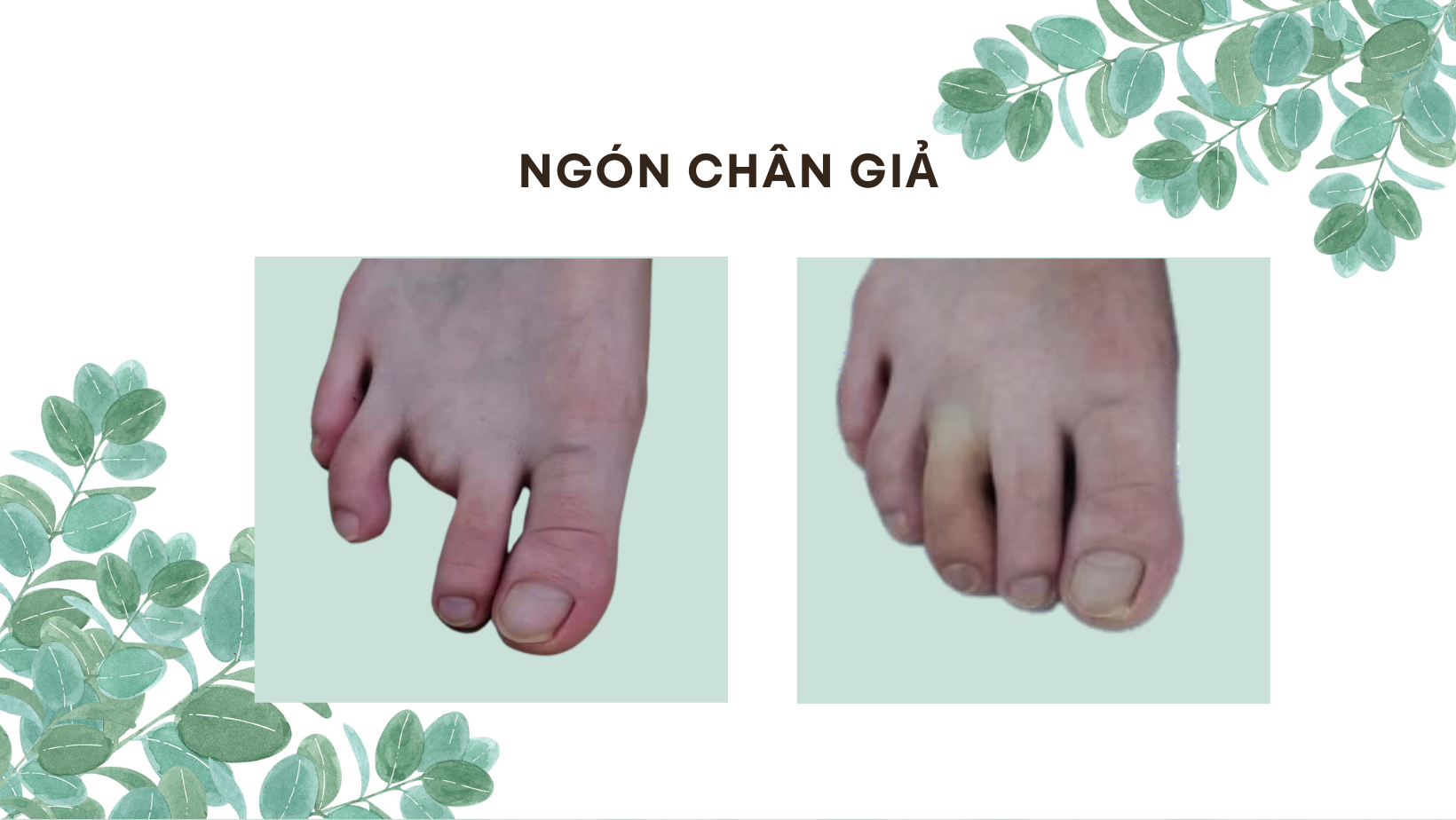 ngón chân giả