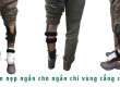chân dùng nẹp chỉnh hình
