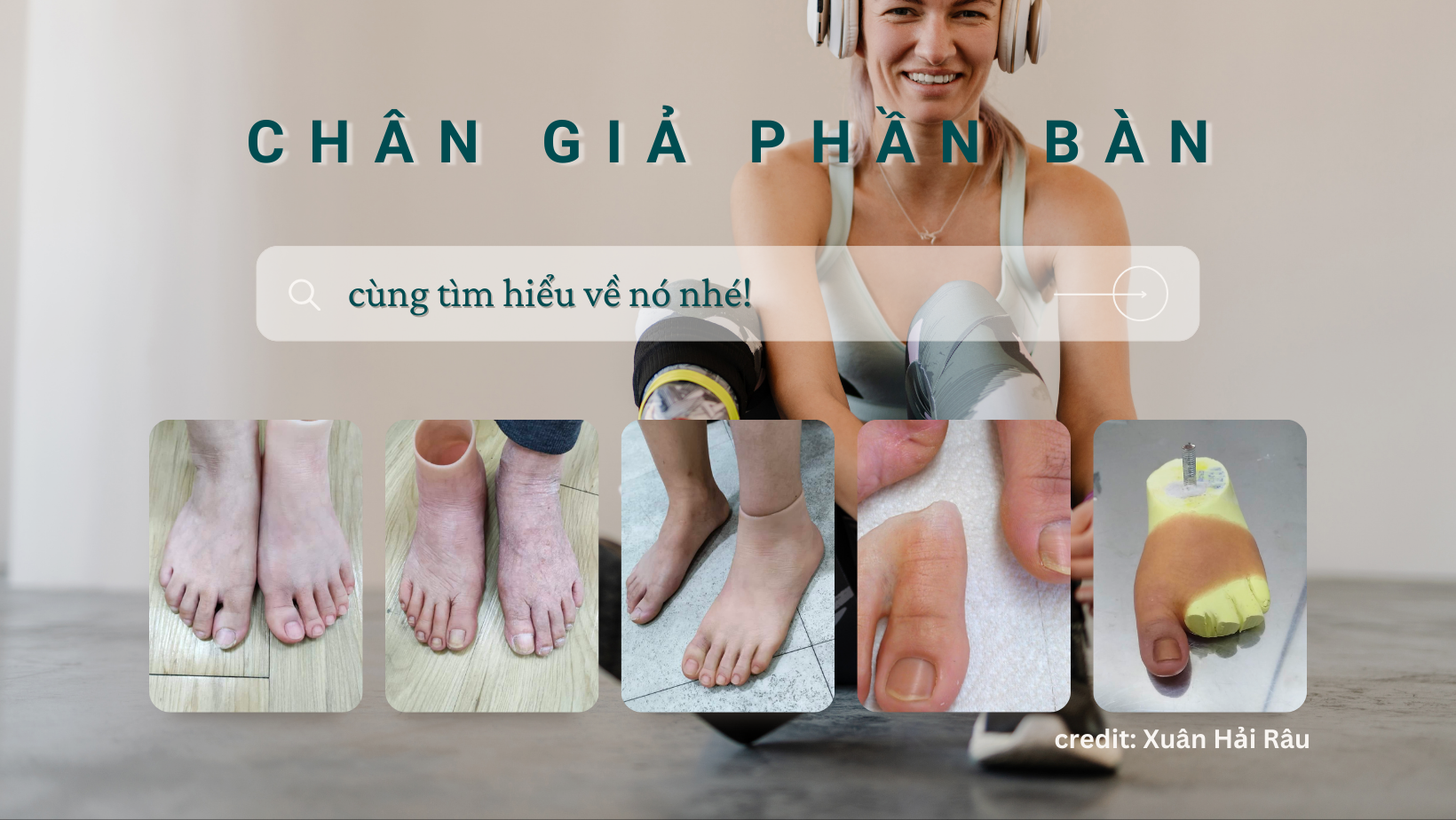 các loại chân giả phần bàn
