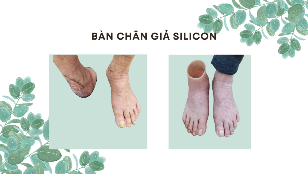 làm chân giả cho người mất bàn chân