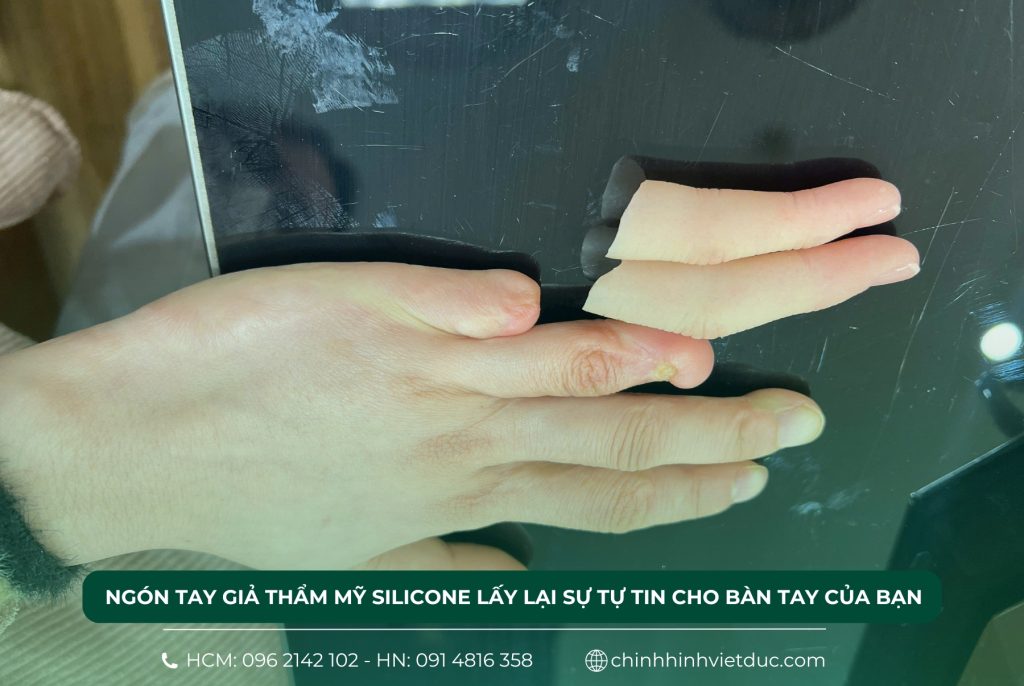 Ngón tay giả thẩm mỹ silicone lấy lại sự tự tin cho bàn tay của bạn