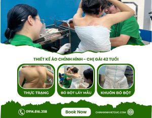 Mẫu áo chỉnh hình cong vẹo cột sống cho chị khách 42 tuổi Hà Nội