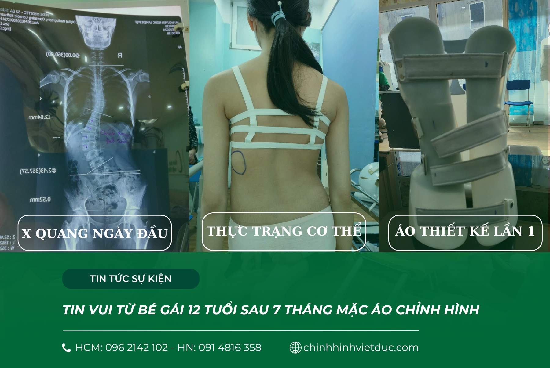 kết quả áo chỉnh hình của bạn gái 13 tuổi