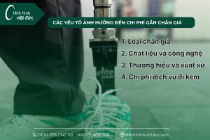 Chi phí gắn chân giả những điều cần biết trước khi quyết định