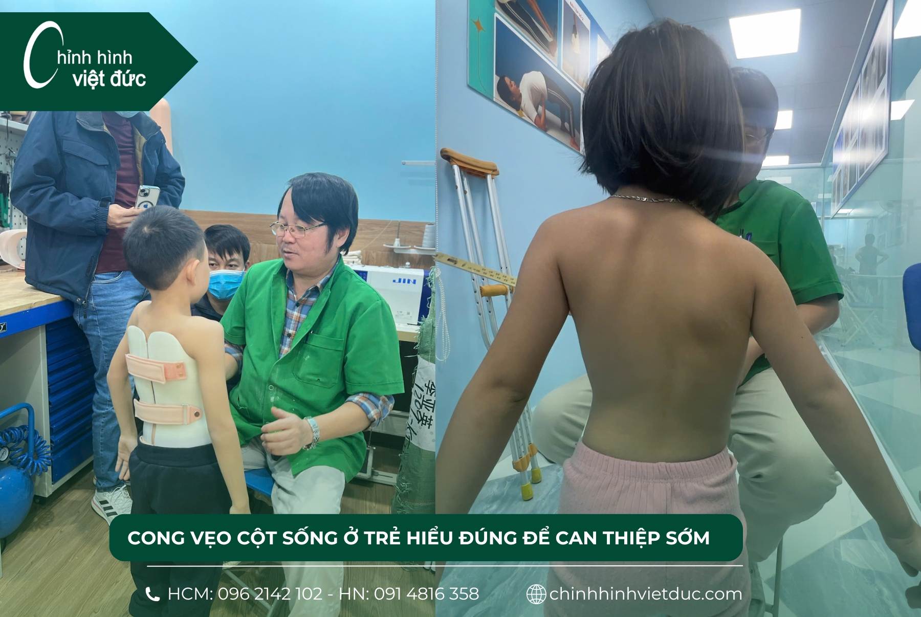 cong vẹo cột sống ở trẻ