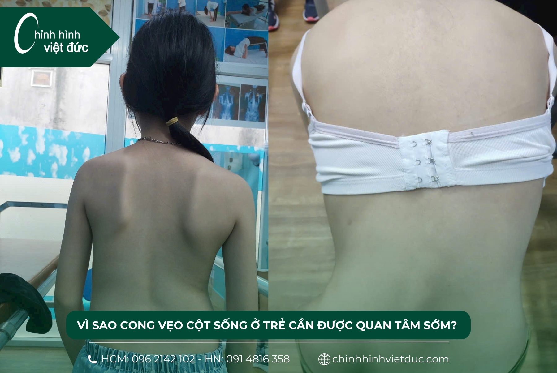 cong vẹo cột sống ở trẻ