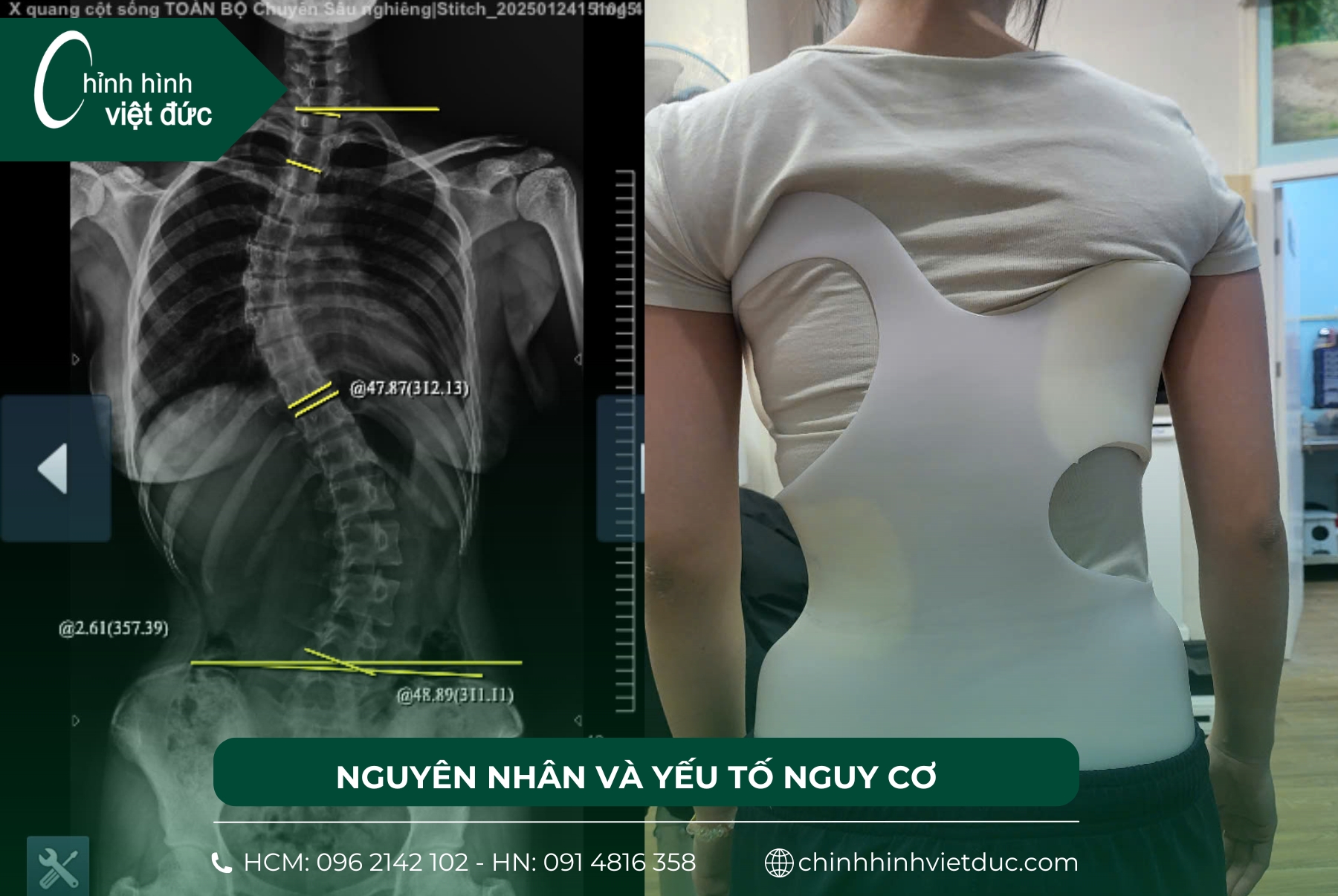 cong vẹo cột sống ở trẻ
