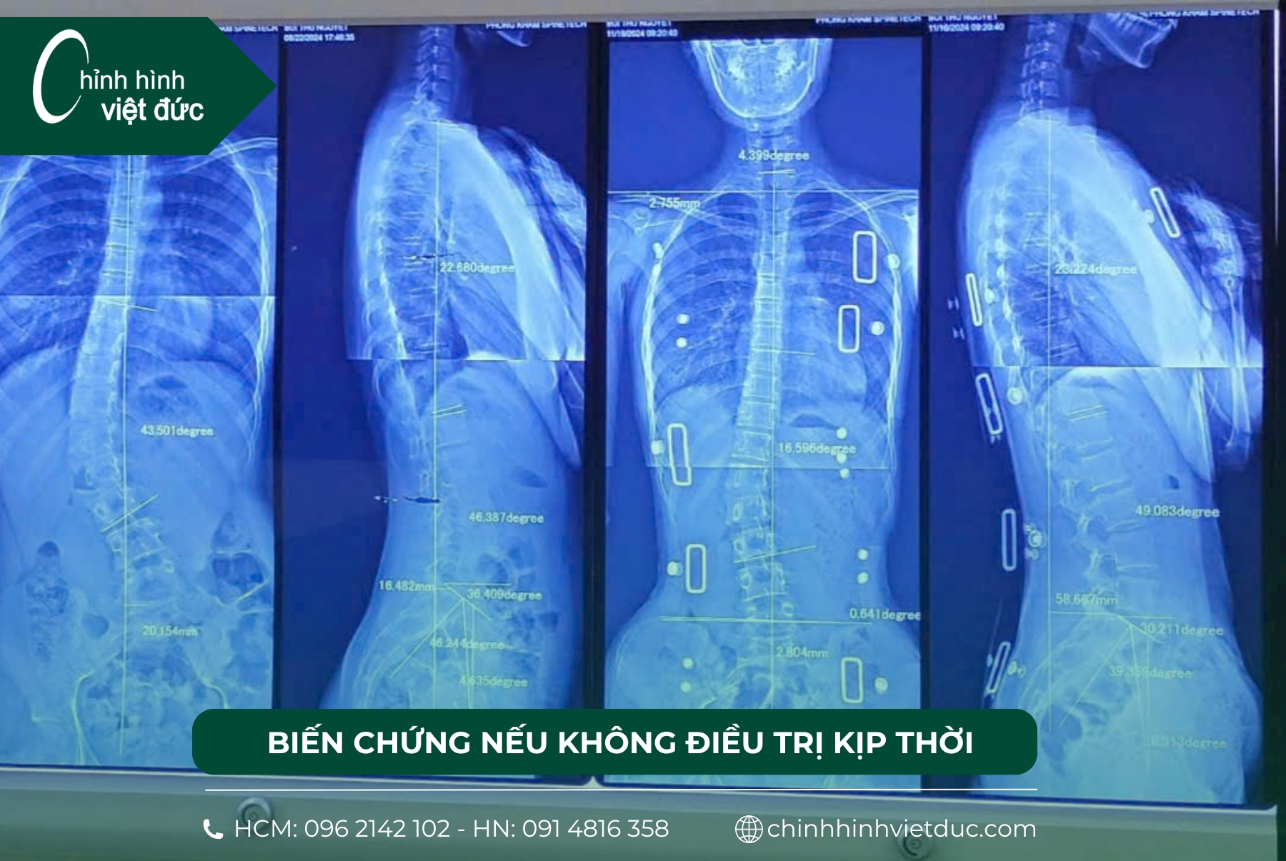 cong vẹo cột sống ở trẻ