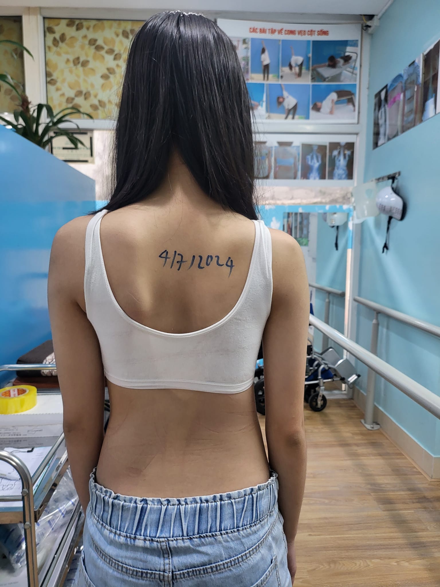kết quả sau khi mặc áo chỉnh hình