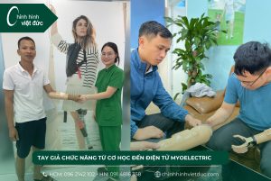 tay giả chức năng