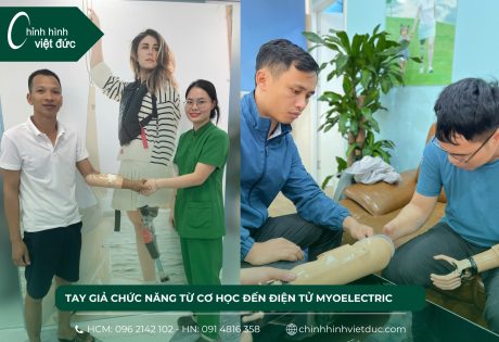 tay giả chức năng