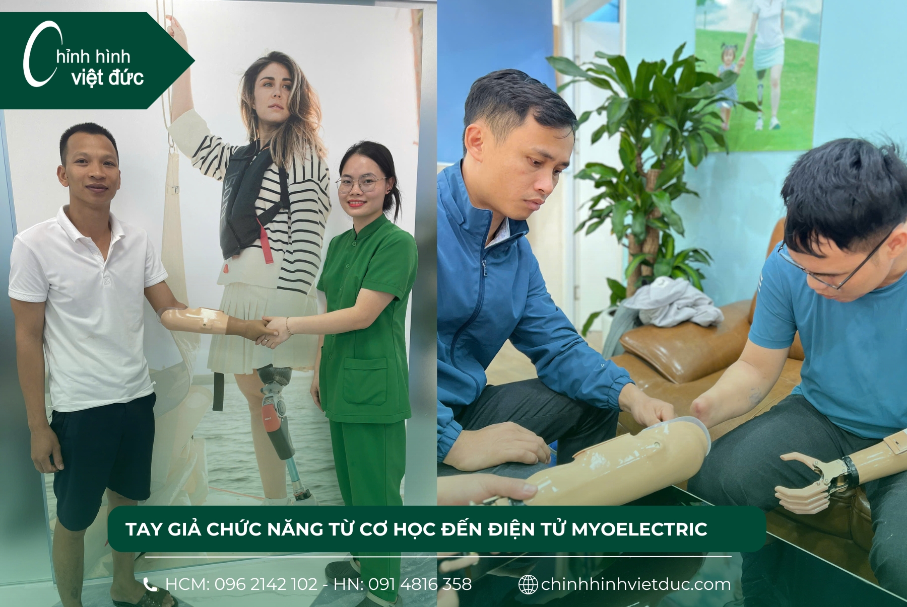 tay giả chức năng
