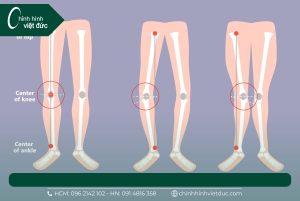 Nẹp chân vòng kiềng cho bé tất tần tật kiến thức cần biết