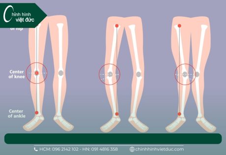 nẹp chân vòng kiềng cho bé