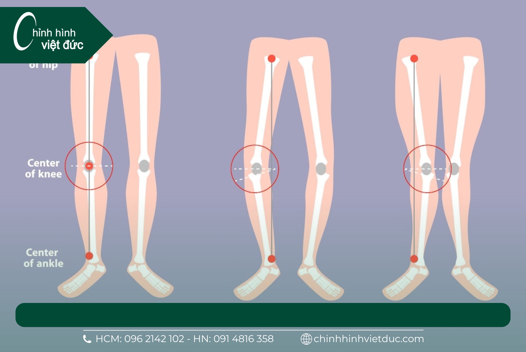 nẹp chân vòng kiềng cho bé