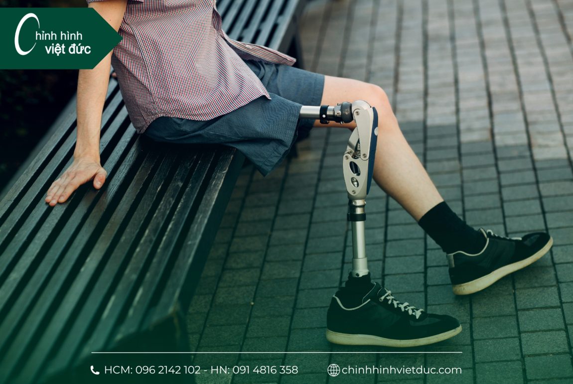 Chân giả thông minh có phải lựa chọn tốt nhất cho người dùng