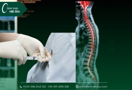 chi phí cho 1 ca phẫu thuật cong vẹo cột sống là bao nhiêu