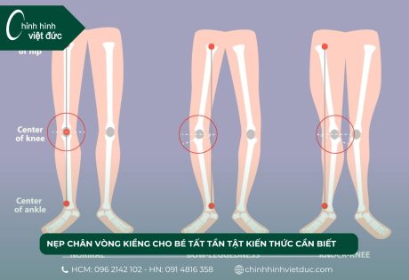 nẹp chân vòng kiềng cho bé