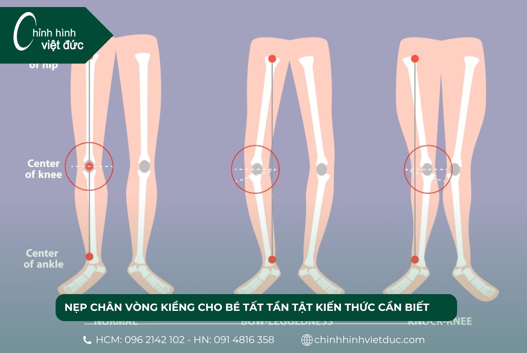 nẹp chân vòng kiềng cho bé