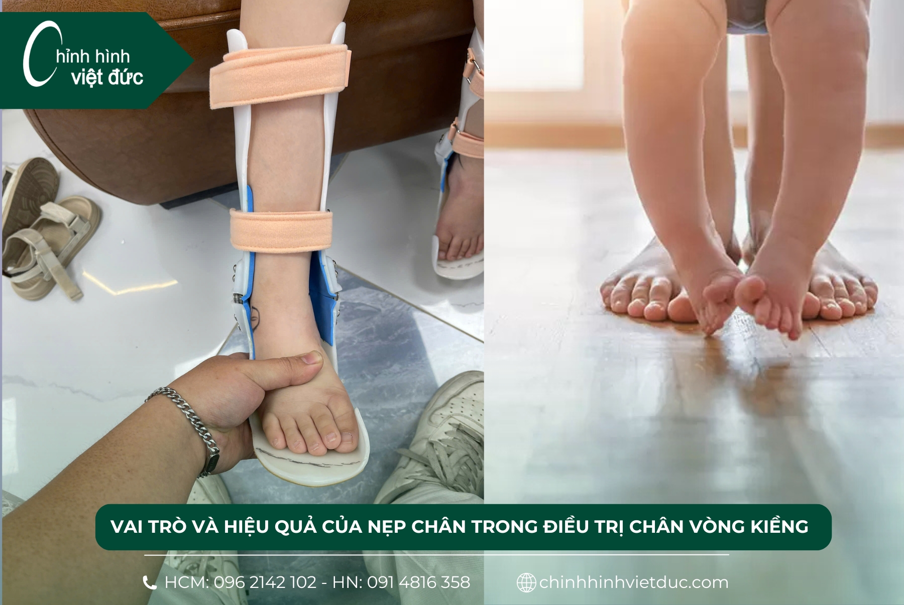 nẹp chân vòng kiềng cho bé