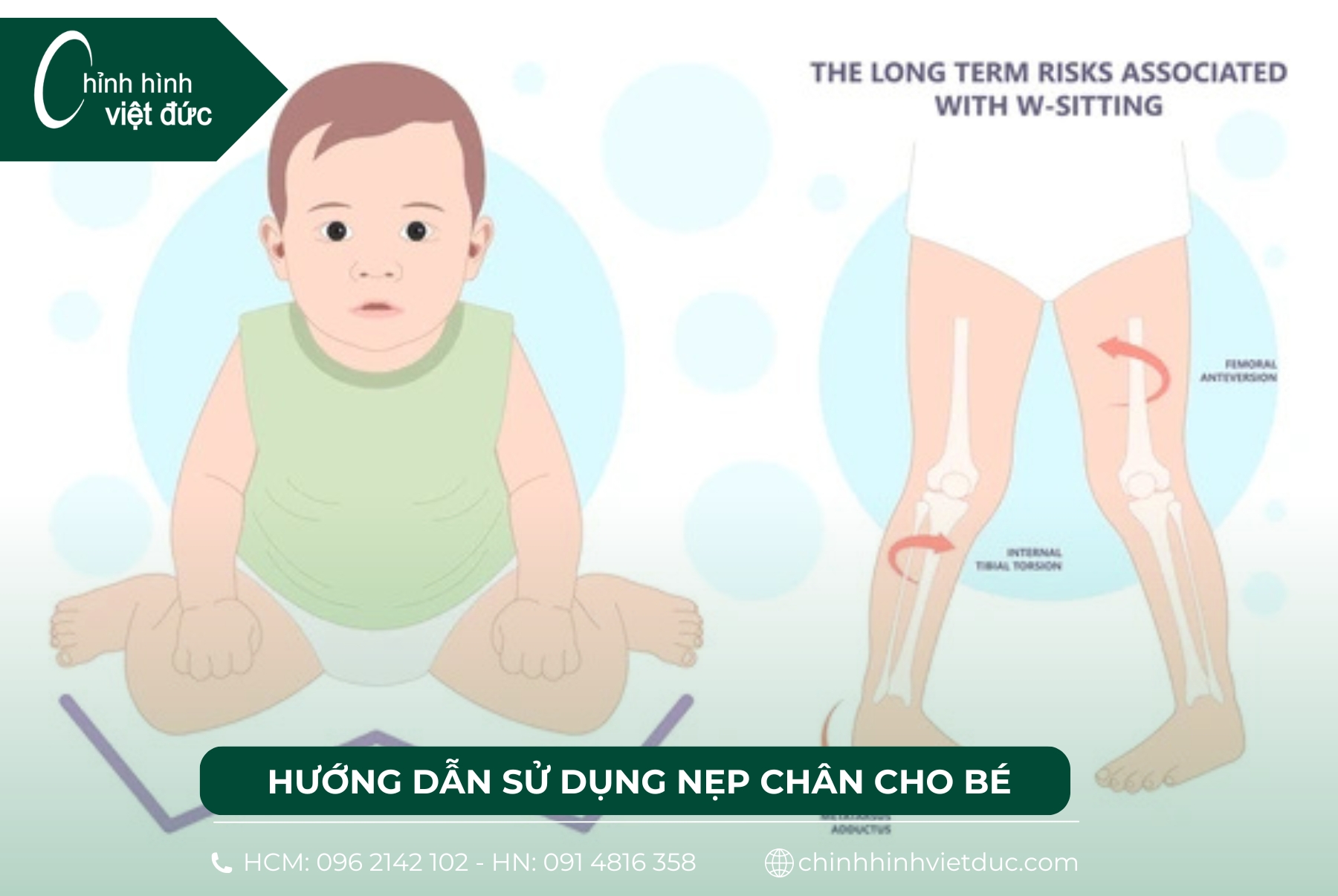 nẹp chân vòng kiềng cho bé