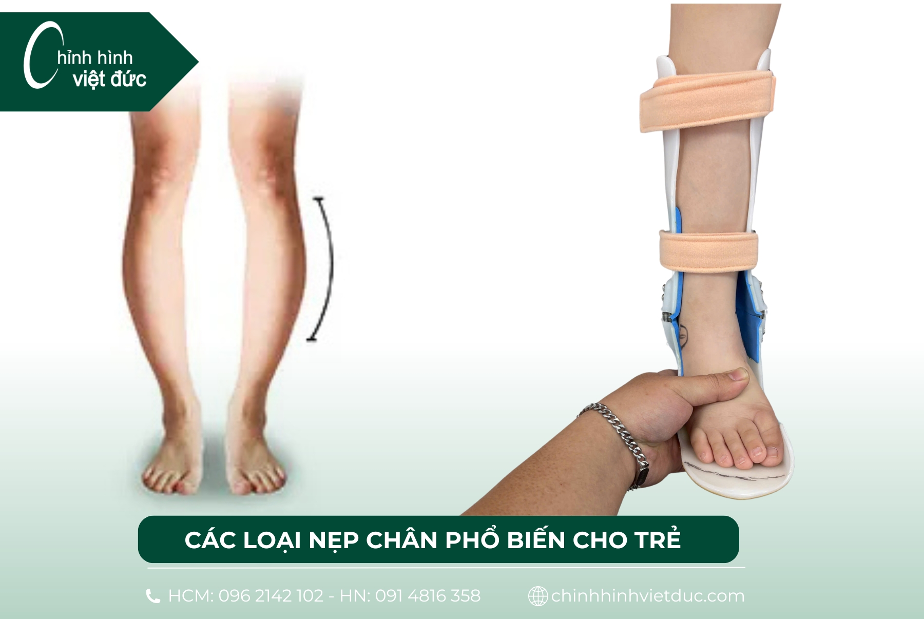 nẹp chân vòng kiềng cho bé