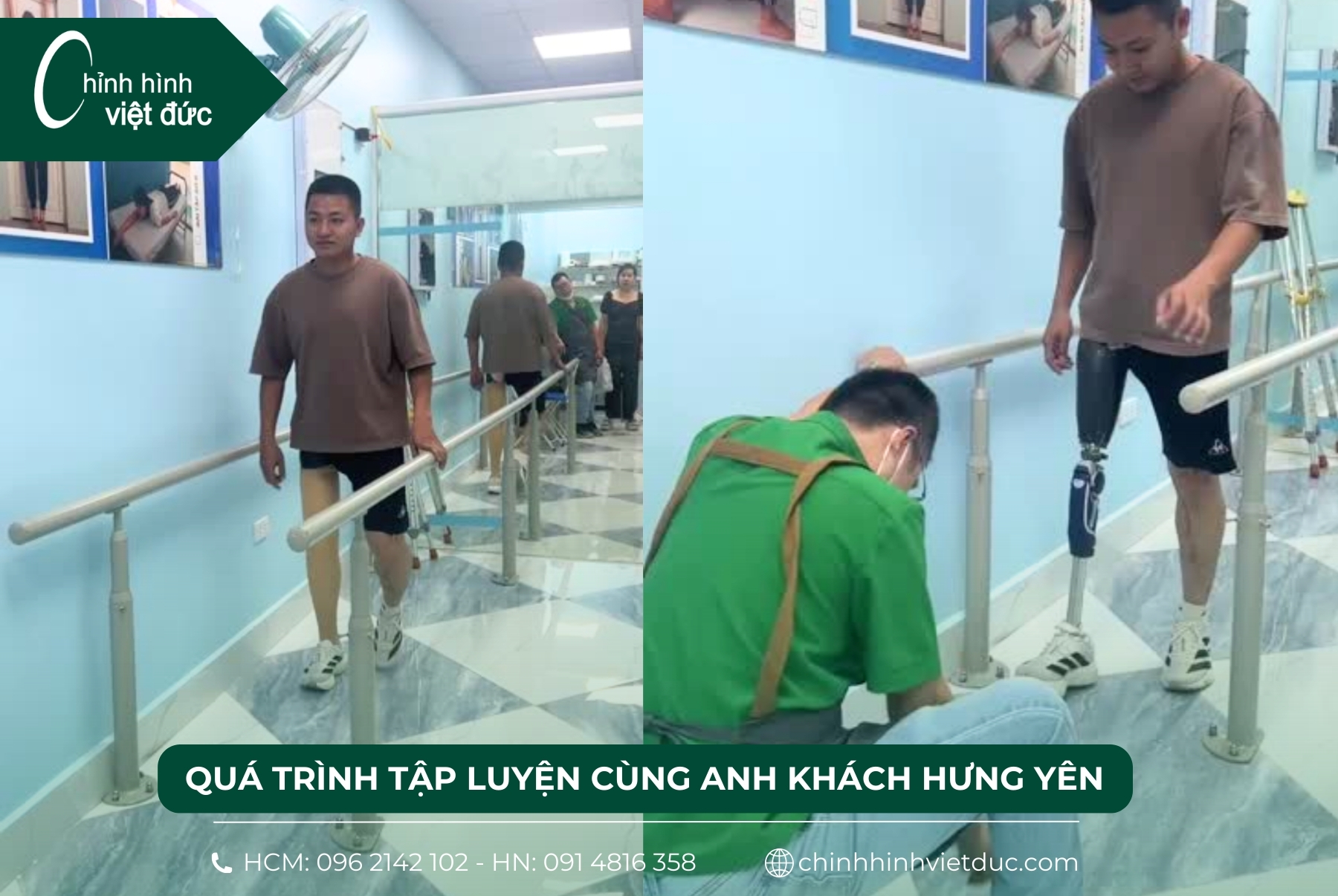 tập đi chân giả trên gối 
