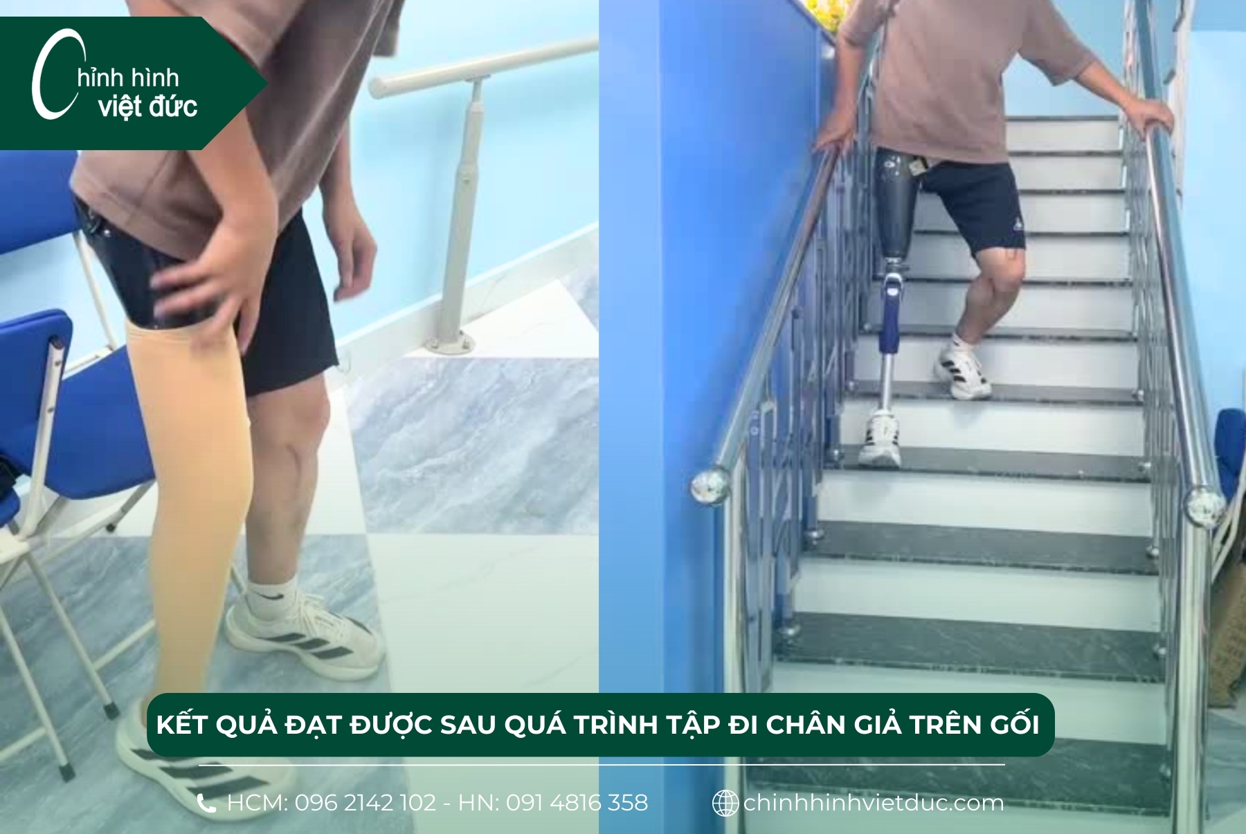 tập đi chân giả trên gối 