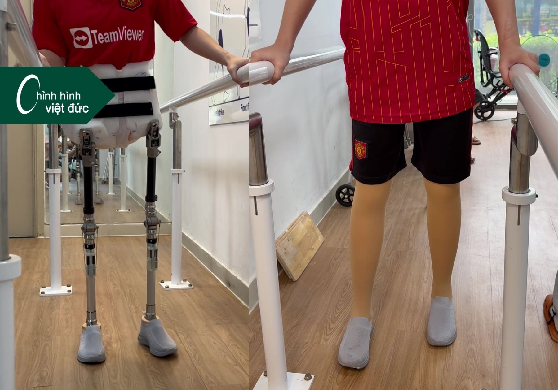 chân giả mất khớp hông giá bao nhiêu