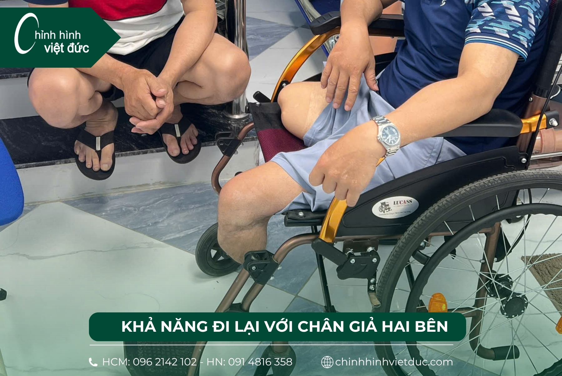 Mất 2 chân làm chân giả có đi được không?