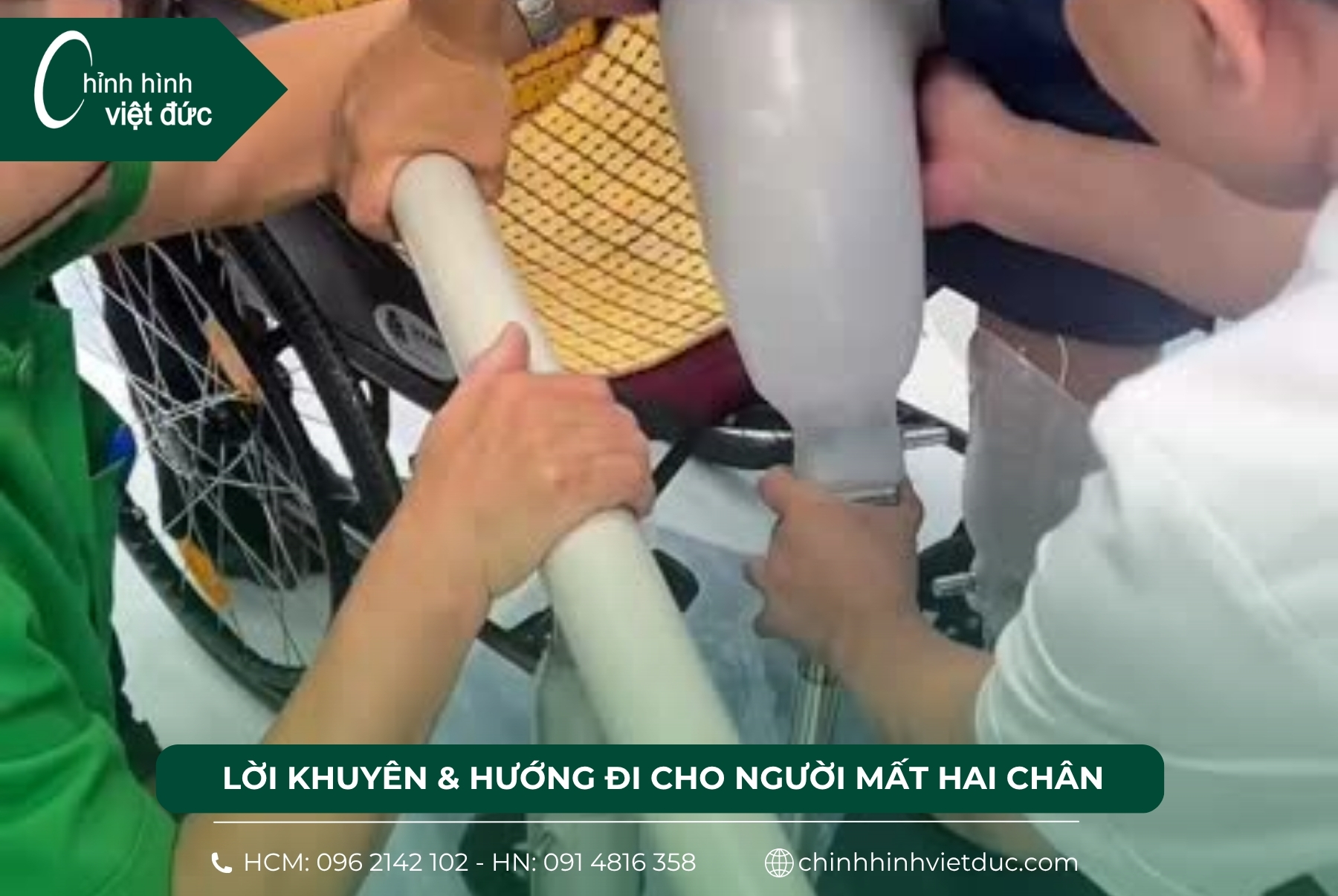 Mất 2 chân làm chân giả có đi được không?