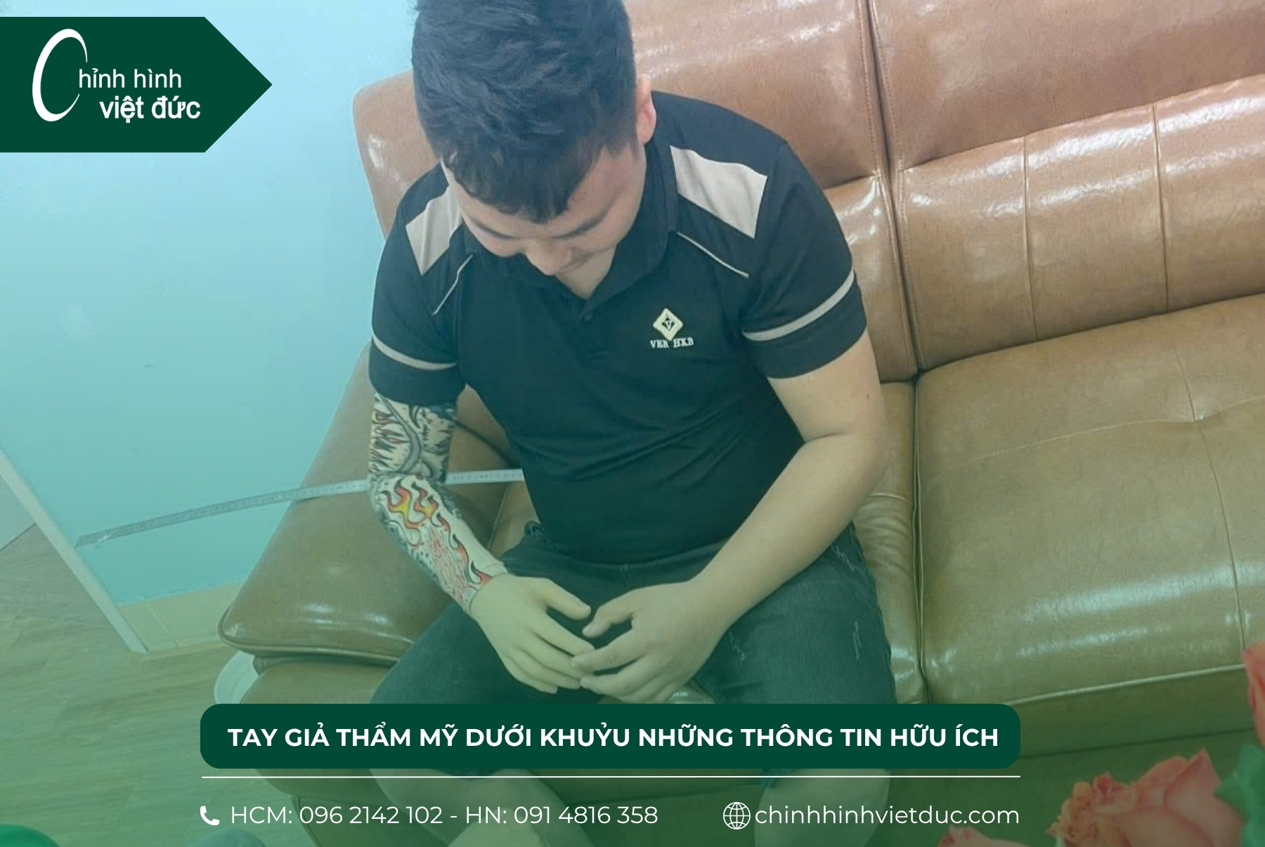 tay giả thẩm mỹ