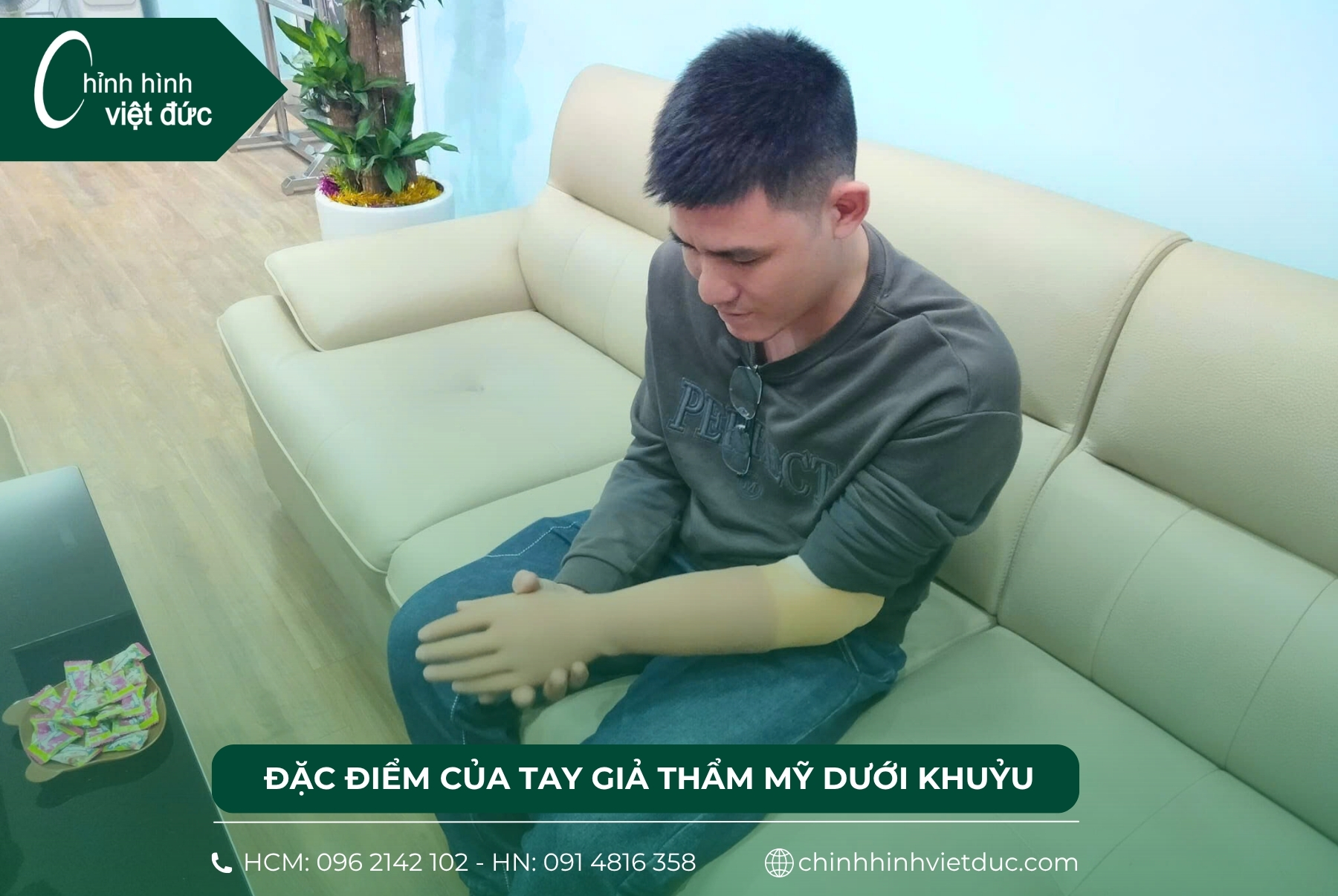 tay giả thẩm mỹ dưới khuỷu