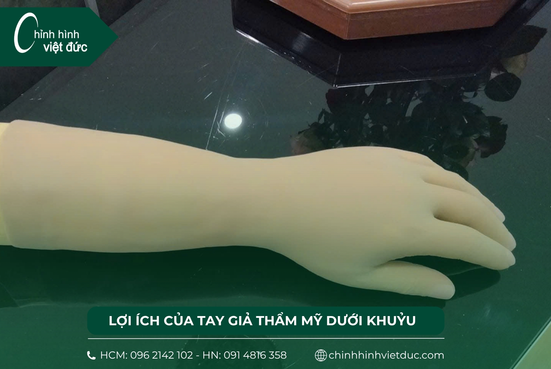 tay giả thẩm mỹ dưới khuỷu