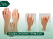 tay giả thẩm mỹ dưới khuỷu