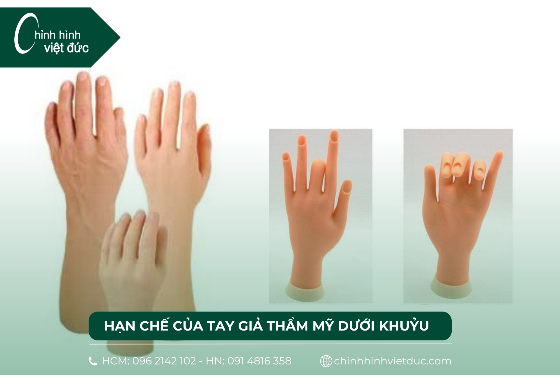 tay giả thẩm mỹ dưới khuỷu