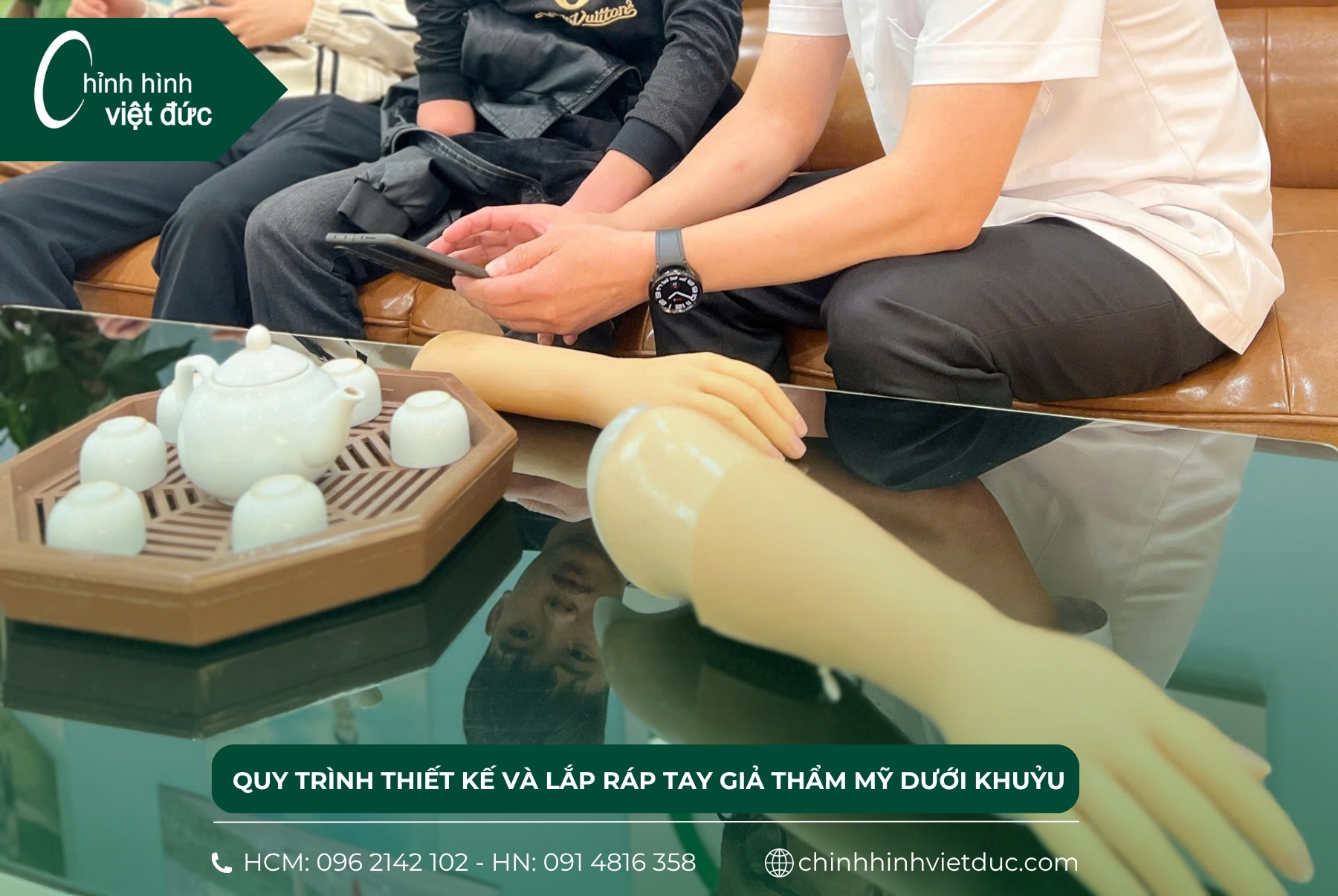 tay giả thẩm mỹ dưới khuỷu