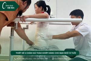 Thiết kế 2 chân giả tháo khớp háng cho bạn nhỏ 13 tuổi