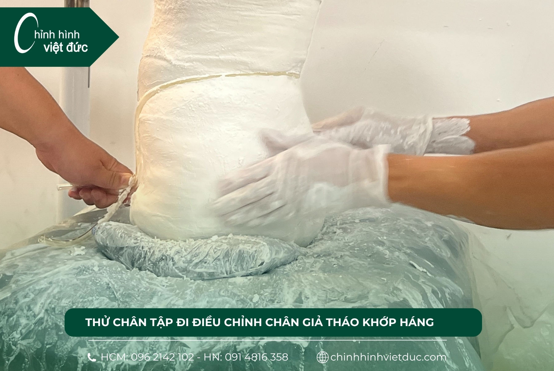 2 chân tháo khớp háng