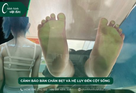 bàn chân bẹt và hệ lụy