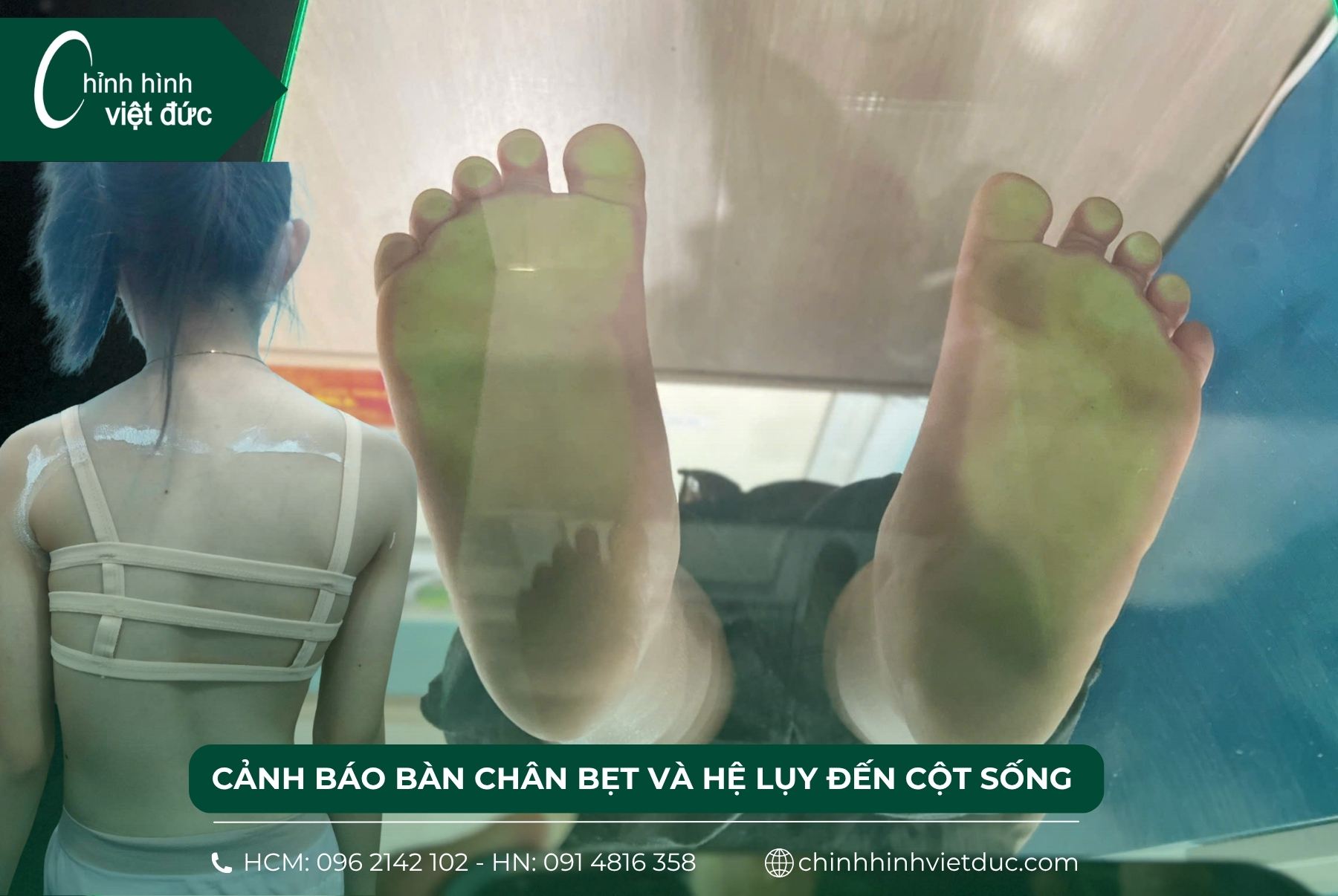 bàn chân bẹt và hệ lụy