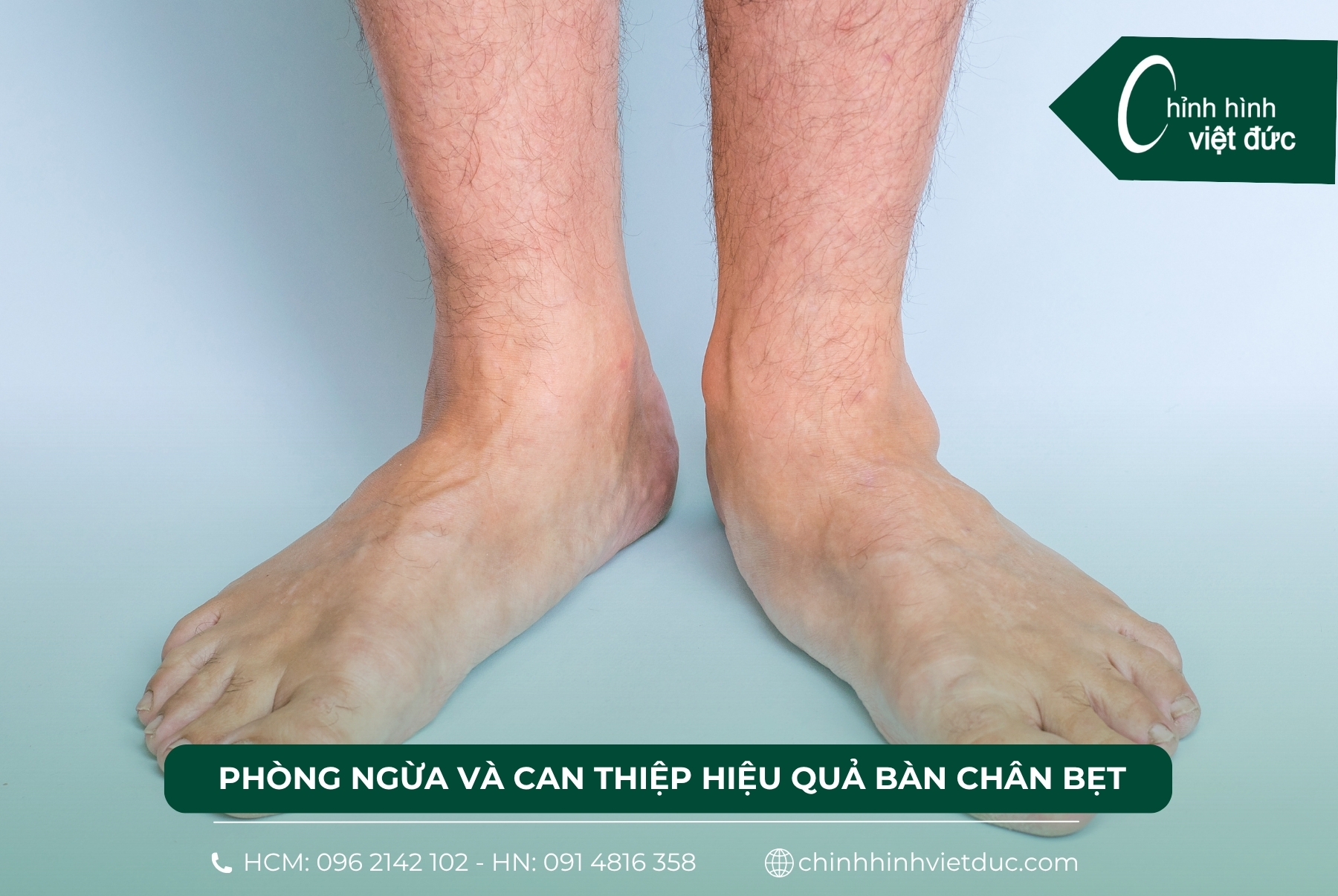 bàn chân bẹt và hệ lụy