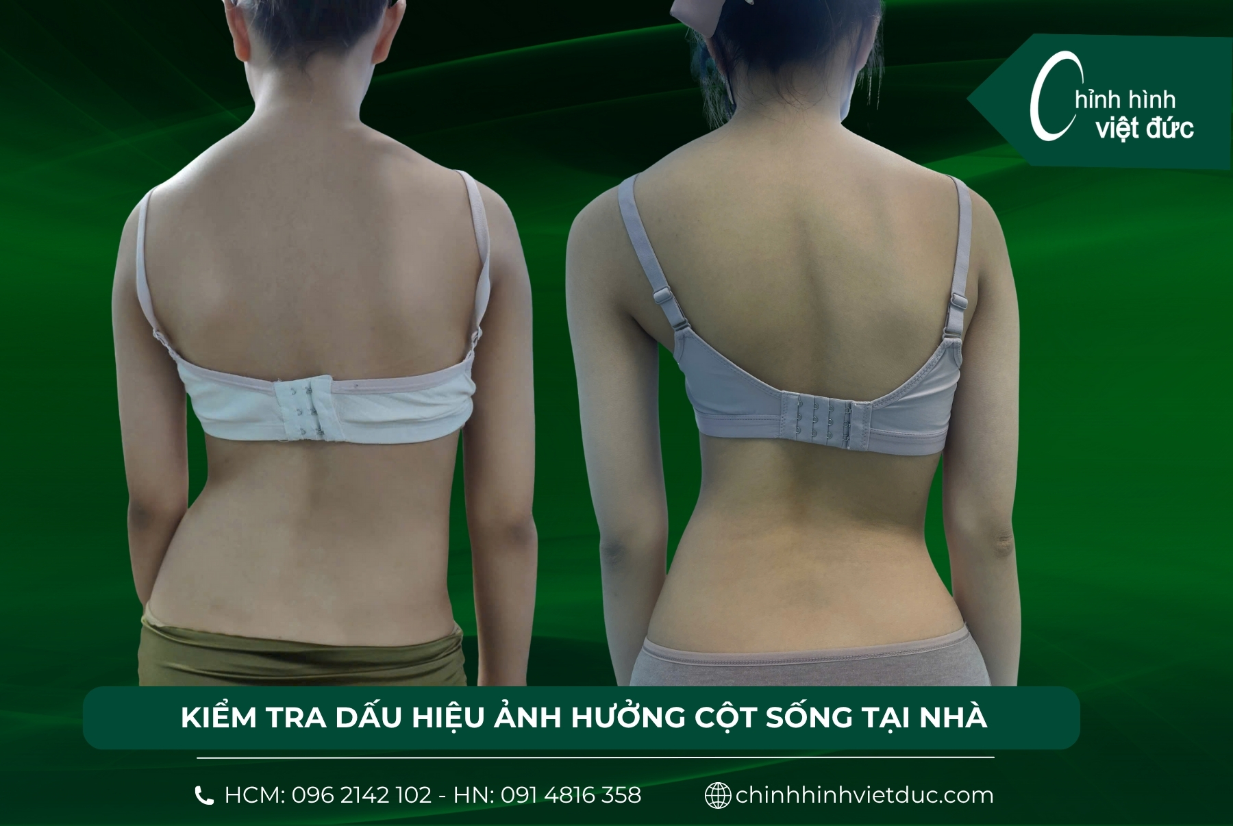 bàn chân bẹt và hệ lụy